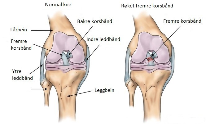LFI Helse Trening ACL